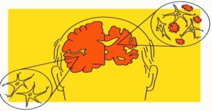 Alzheimer's Disease